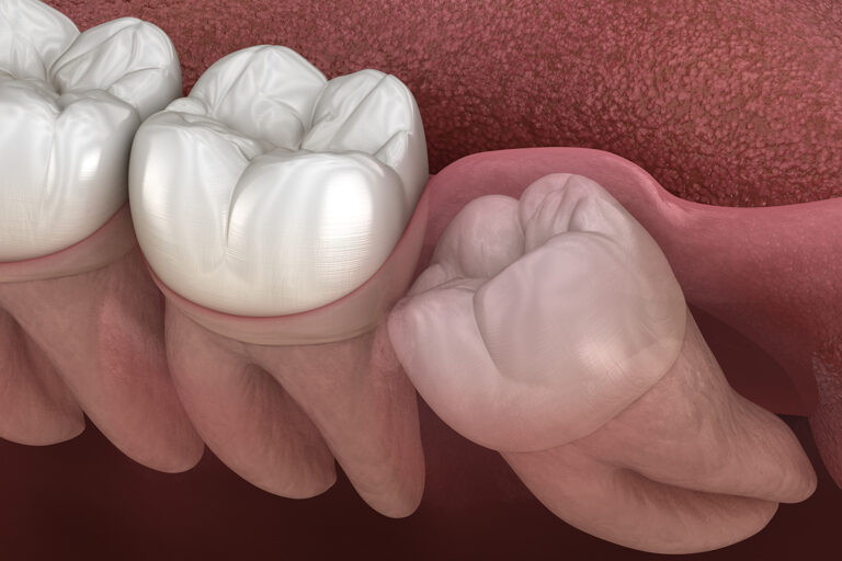 Extraction of Wisdom Teeth