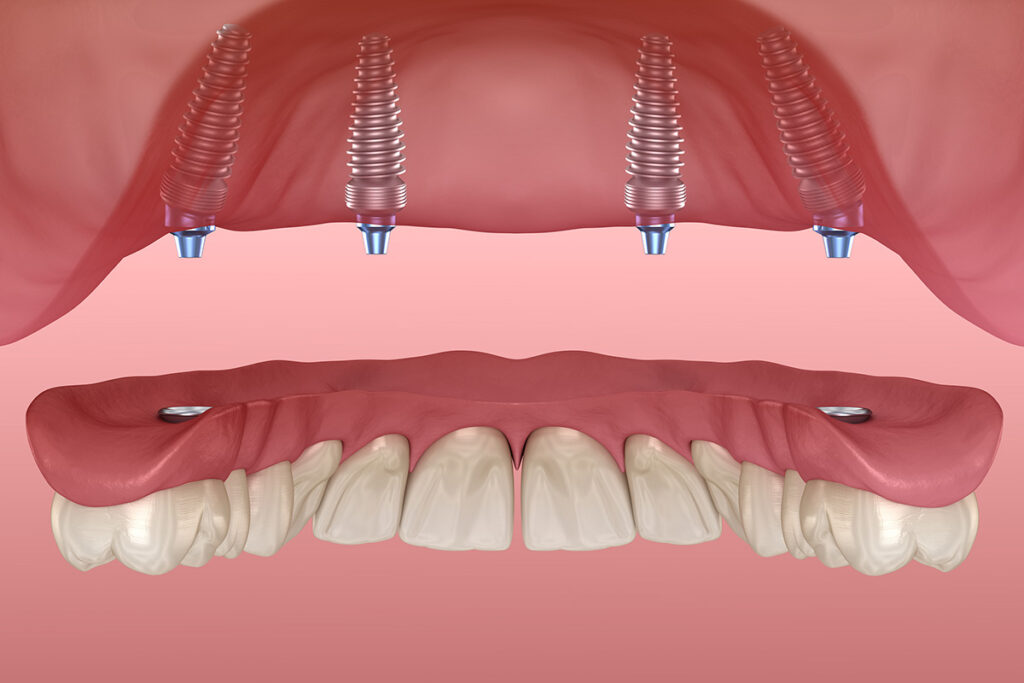 best-types-of-dental-prosthetics-3-secrets-of-the-right-choice