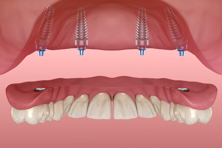 Dental Prosthetics: Types, Features, Prices