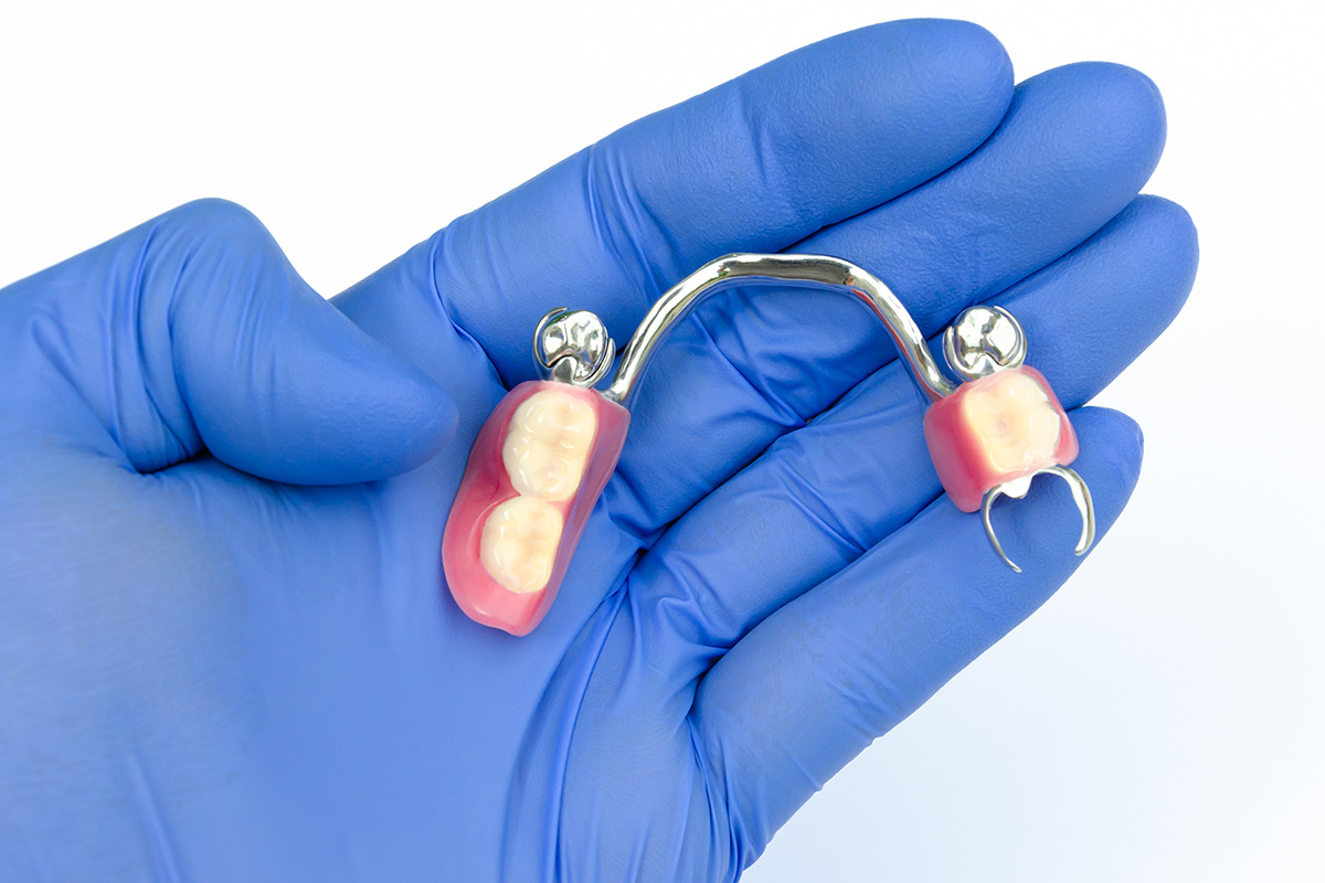 What is a Clasp Dental Prosthesis?