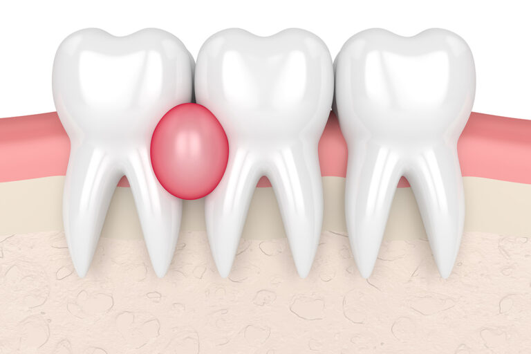 Tooth Granuloma: Causes, Symptoms, Diagnostics, and Treatment