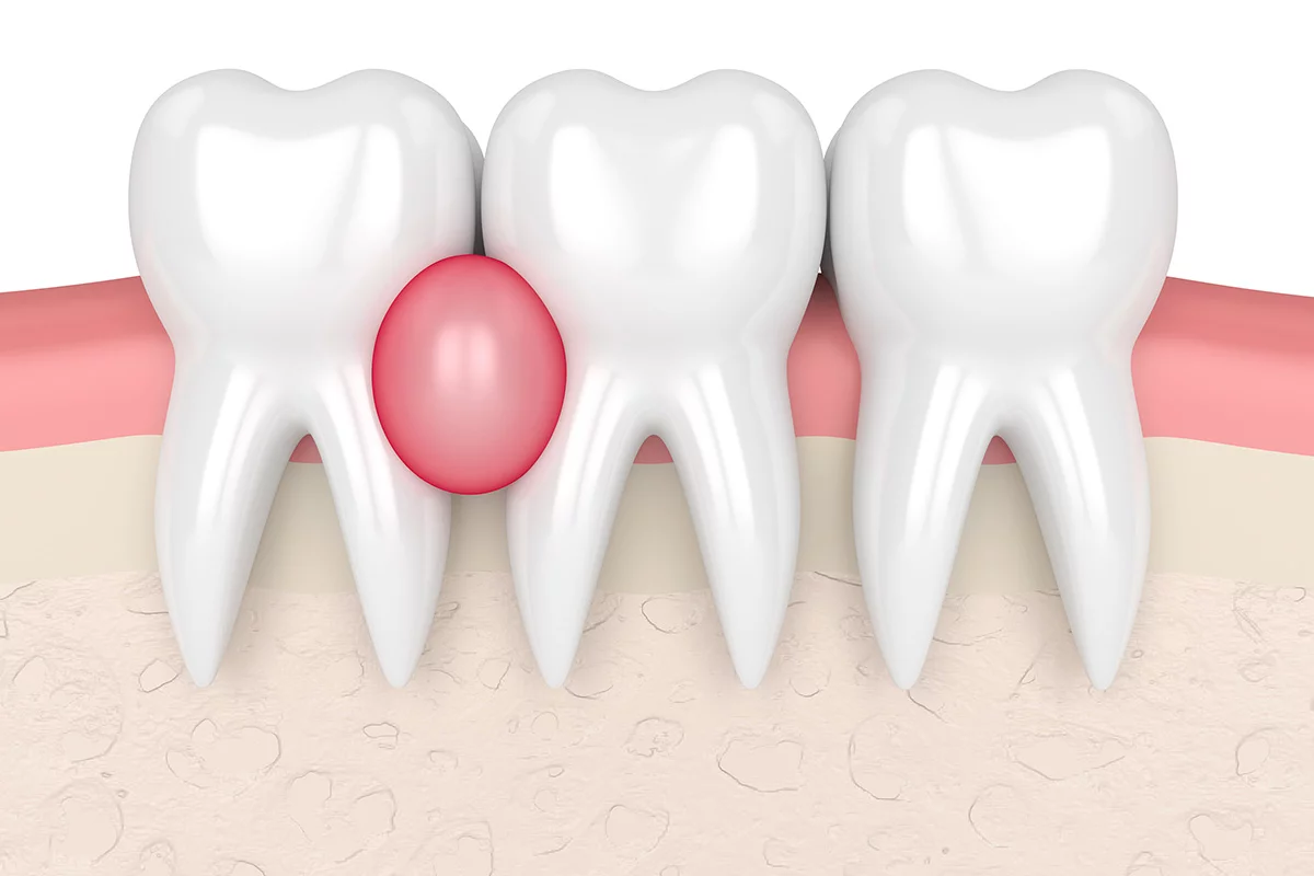 Granulomul dentar: cauze, simptome, diagnostic și tratament