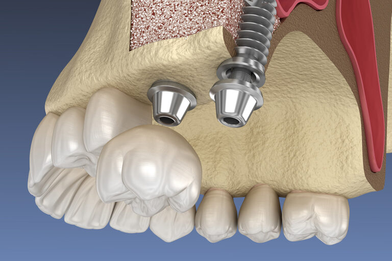 Sinus-lifting: Ce este și când este necesar?