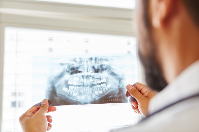 Rimozione delle cisti dentali